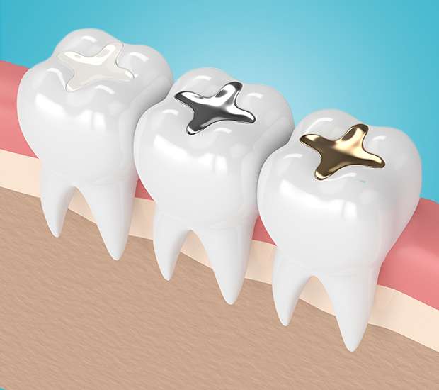 Agoura Hills Composite Fillings