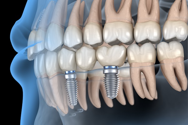 Are There Different Types Of Dental Bridge?