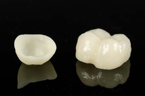 What To Do About A Loose Dental Crown