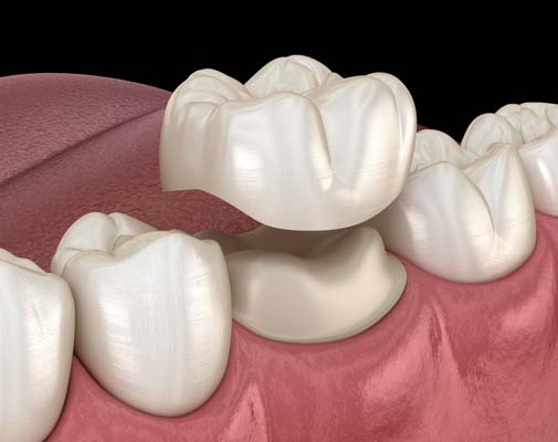 What To Expect In A Dental Crown Procedure