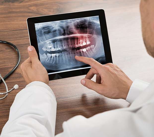 Agoura Hills Types of Dental Root Fractures